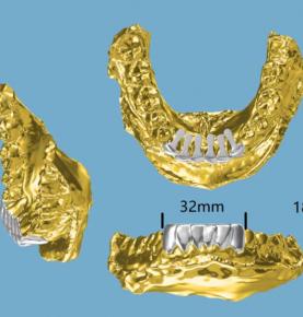 Grillz for teeth